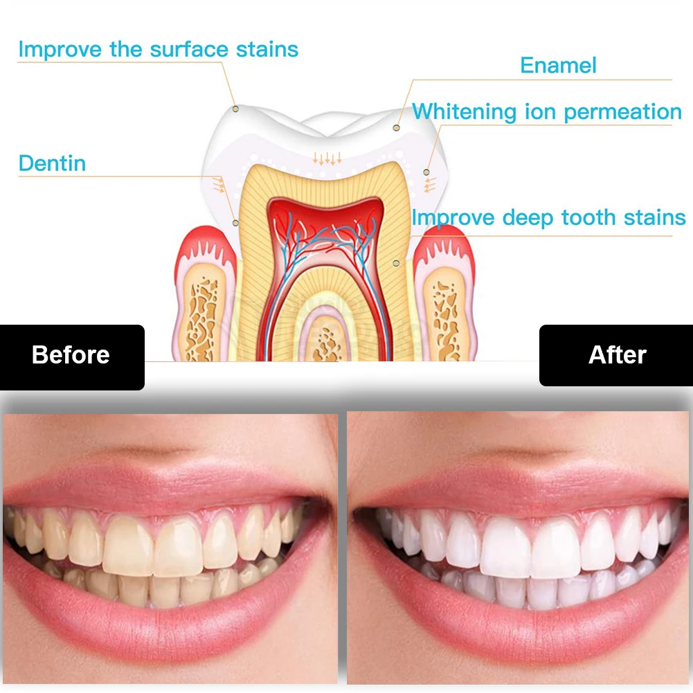 ทันตกรรมชุดฟอกสีฟัน Mini 16 LE - Teeth Whitening Near Me บทวิจารณ์และราคา